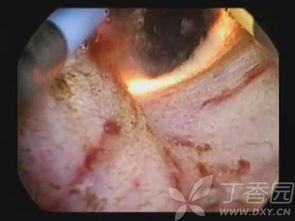 前列腺手术视频,技术革新与术后康复要点